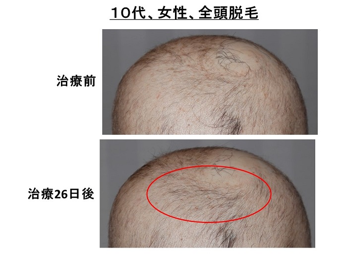円形脱毛症　病院